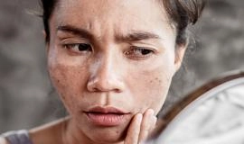 11 tác hại của kem trị nám kém chất lượng và cách khắc phục