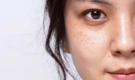 Trị Nám Chân Đinh: Nguyên Nhân Và Dấu Hiệu Nhận Biết