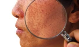 12 Nguyên nhân gây nám da ở phụ nữ và cách điều trị hiệu quả