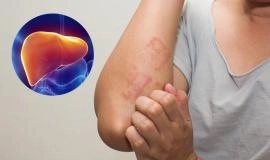 Các Dấu Hiệu Nóng Gan Thường Gặp & Cách Phòng Ngừa