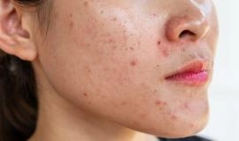 Nguyên Nhân Uống Thải Độc Gan Bị Nổi Mụn