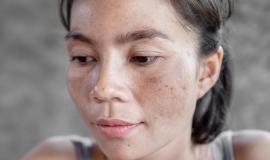 Nám Mảng Là Gì? Nguyên Nhân Và 5 Cách Điều Trị Hiệu Quả