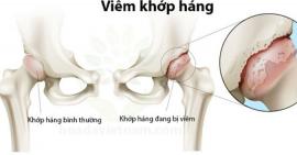 Nguyên nhân và cách điều trị bệnh viêm khớp háng