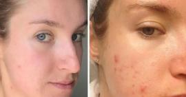 8 dấu hiệu nhận biết cơ thể đang bị dư thừa estrogen chị em cần biết