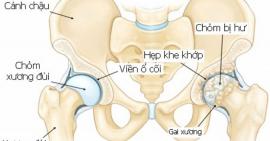 Những dấu hiệu và nguyên nhân điều trị bệnh thoái hóa khớp háng