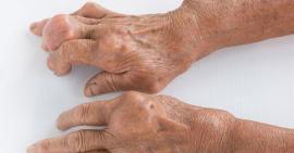 Những biến chứng nguy hiểm thường gặp của bệnh gout