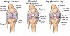 7 loại thực phẩm rất tốt cho người bị thoái hóa khớp gối