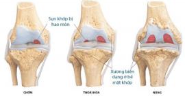 Người bị viêm xương khớp nên ăn những gì?