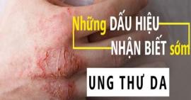 Những dấu hiệu nhận biết sớm của bệnh ung thư da