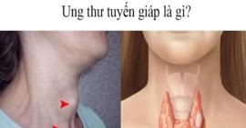 Tìm hiểu nguyên nhân và biện pháp phòng tránh bệnh ung thư tuyến giáp
