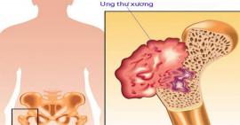 Bạn biết gì về căn bệnh ung thư xương?