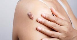 Một số thực phẩm giúp vết thương mau lành hơn