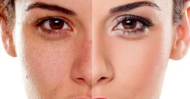 Nguyên nhân và cách điều trị bệnh sạm da