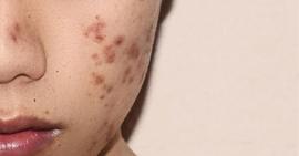 Thói quen dùng khăn tắm lau mặt nguy hại cho da mà bạn không ngờ tới