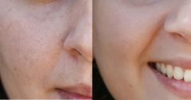 Chia sẻ 10 mẹo se khít lỗ chân lông giúp bạn luôn rạng ngời