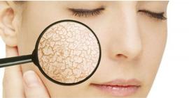 3 điều quan trọng cần lưu ý khi chăm sóc da khô