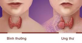 Các căn bệnh ung thư thường gặp ở phụ nữ
