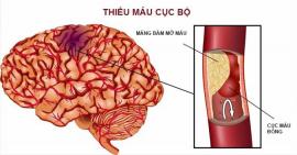 Đột quỵ do thiếu máu não cục bộ