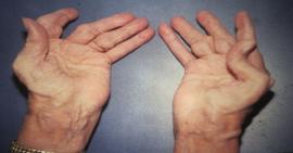 Viêm khớp dạng thấp sẽ gây cho bạn nhiều hậu quả nguy hiểm