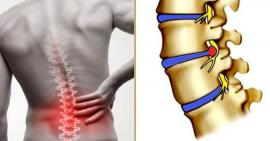 Bệnh thoát vị đĩa đệm lưng có những dấu hiệu nào phổ biến