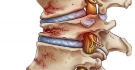 Tất tần tật về xẹp đốt sống