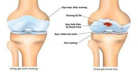 Thoái hoá khớp có những biến chứng gì?