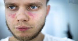 Bệnh Lupus ban đỏ có ảnh hưởng gì đến xương khớp hay không?