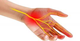 Nguyên nhân và cách điều trị hội chứng ống cổ tay