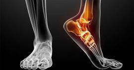 Phương pháp bó thuốc gia truyền điều trị trật khớp có hiệu quả như lời đồn