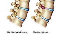 Phương pháp đẩy lùi thoát vị đĩa đệm mà không cần phẫu thuật hay uống thuốc