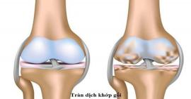 Nguyên nhân và cách điều trị khi bị tràn dịch khớp gối