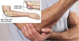 Những thông tin bạn cần biết về viêm bao hoạt dịch