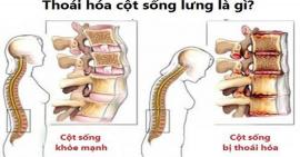 Tất tần tật về thoái hoá cột sống lưng bạn cần biết