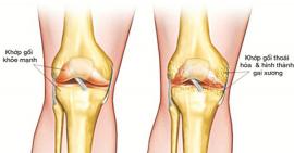 Những điều bạn cần biết về thoái hoá khớp gối