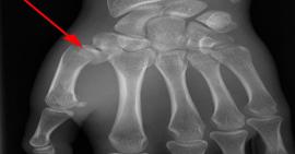 Gãy Bennett-Gãy xương đấm bốc