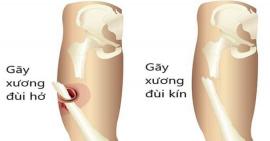 Đừng chủ quan tình trạng gãy xương đùi