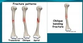 Gãy cánh tay và những điều bạn cần biết
