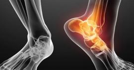 3 sai lầm thường mắc phải khi xử lý chấn thương trật khớp bàn chân