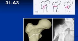Triệu chứng và phương pháp điều trị gãy mấu chuyển xương đùi