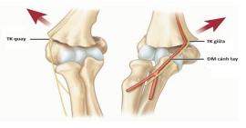 Cảnh báo trẻ em có nguy cơ gãy liên lồi cầu xương cánh tay
