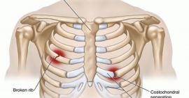 Những điều bạn cần biết về gãy xương sườn