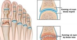 Thoái hoá khớp bàn ngón chân báo hiệu nguy cơ tàn phế
