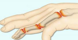 Phòng tránh thoái hoá khớp bàn ngón tay hiệu quả