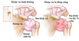 Viêm khớp vai thể đông đặc là chứng bệnh gì?