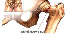 Gãy cổ xương đùi có nguy hiểm hay không?