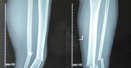 Cảnh báo về biến chứng khi gãy 2 xương cẳng chân