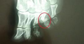 Hiểu biết sai lầm về gãy xương ngón chân mà người bệnh dễ mắc phải