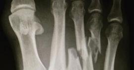 Gãy xương bàn chân bao lâu thì hồi phục?