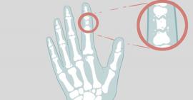 Sơ cứu đúng cách để giảm đau đớn khi bị gãy xương ngón tay