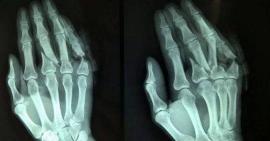 Triệu chứng gãy xương bàn tay bạn cần biết